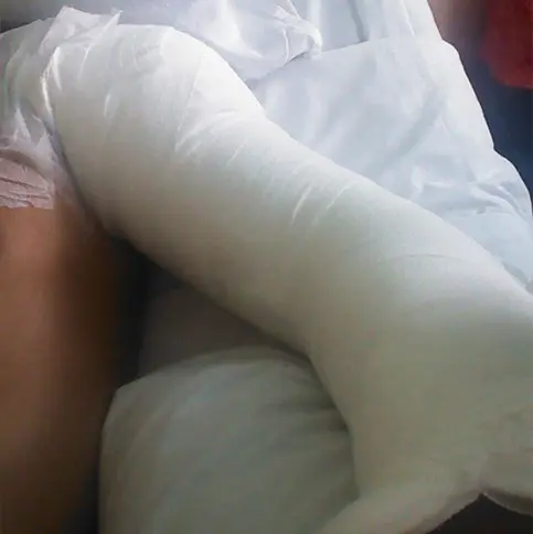 Fisioterapia em Queimados — Antes e Depois 1