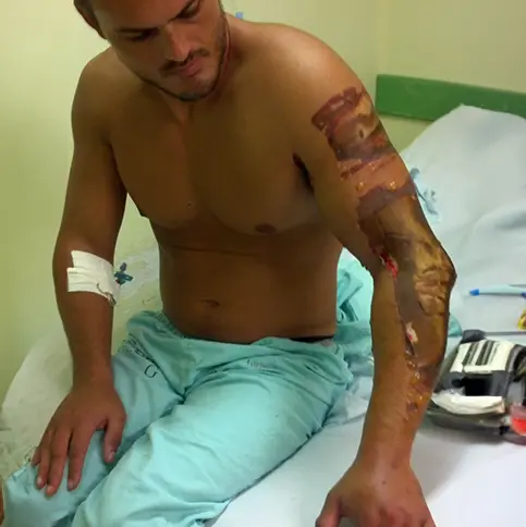 Fisioterapia em Queimados — Antes e Depois 2