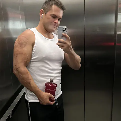 Fisioterapia em Queimados — Antes e Depois 3